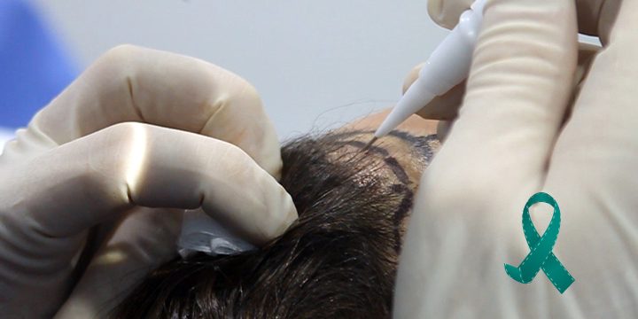 campana-solidaria-trasplante-de-pelo