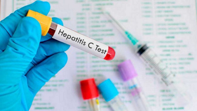 hepatitis c